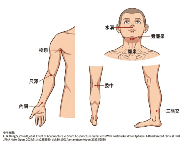 中風失語針灸示意圖